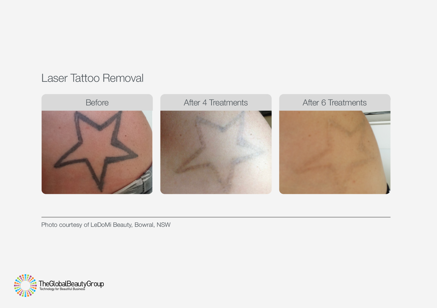 Laser Tattoo Removal Treatment  Tattoo Correction  CUTERA